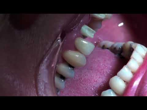 Installing a bridge on dental implants