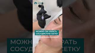 Можно ли убрать сосудистую сетку с помощью биоревитализации?  #советыкосметолога