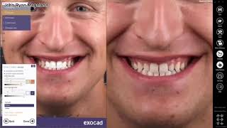 Cad Cam and Smile Design Digital Dentistry