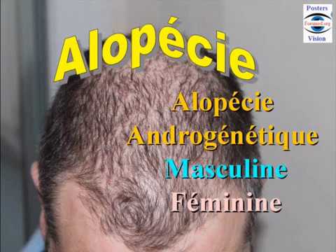 Chute de Cheveux : Alopécie androgenique chez l'Homme et chez la Femme