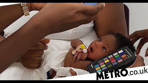 Doctors develop low-cost jaundice detection app to help newborns