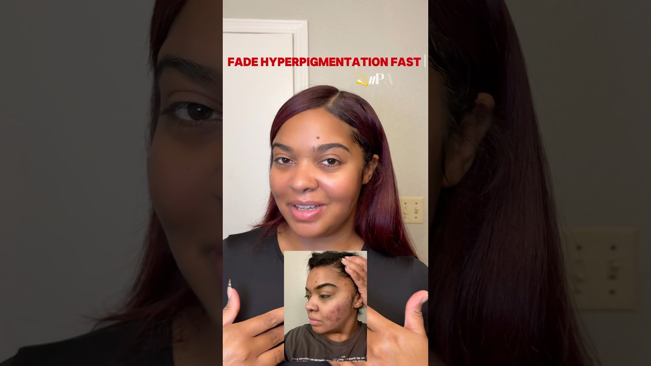 ✨Fade your hyperpigmentation fast 