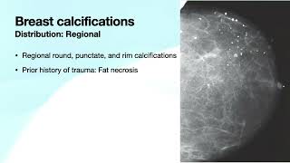 Breast Calcifications Part 2 | Free Radiology CME