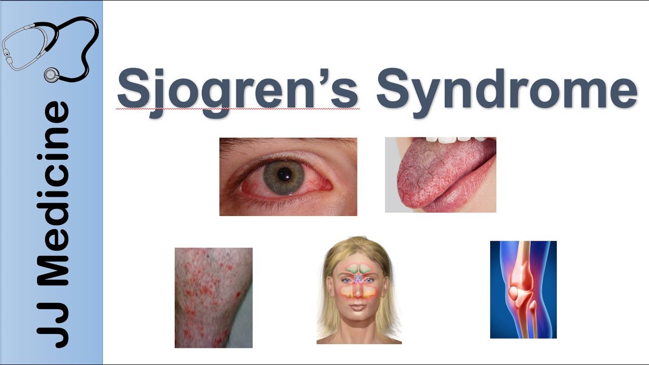 Sjogren's Syndrome: 9 Natural Ways to Manage Self Care - Dr. Axe, Sjogrens fogyás