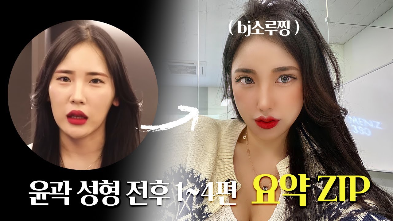 BJ소루찡 1~4편 한 방에 보기 [안면윤곽3종!+ 눈밑지방재배치]