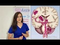Accidente cerebrovascular 🧠 fisiopatología del ACV isquémico y hemorrágico fácil de aprender! Ictus