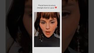 Facial Bone Structure Changes Due To Lupus