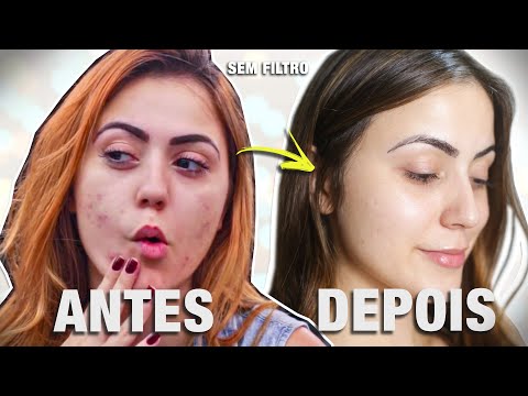 Vídeo: Os Melhores Produtos Orgânicos Para Peles Com Tendência A Acne