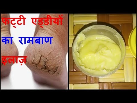 फटी एड़ियां से छुटकारा पाये - Cracked Heels Home Remedy ||ब्यूटी सीक्रेट्स - YouTube