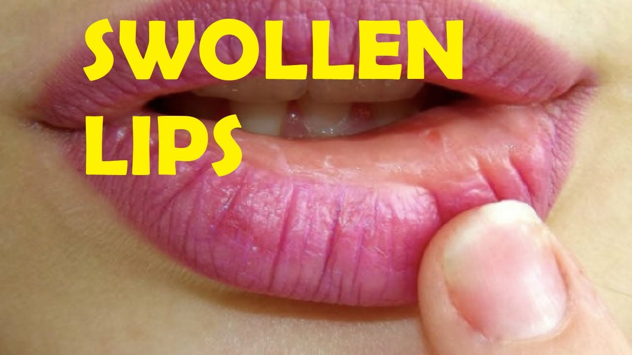 How To Get Rid Of Swollen Lips After Kissing