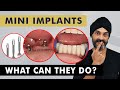 Mini Dental Implants What Can They Do