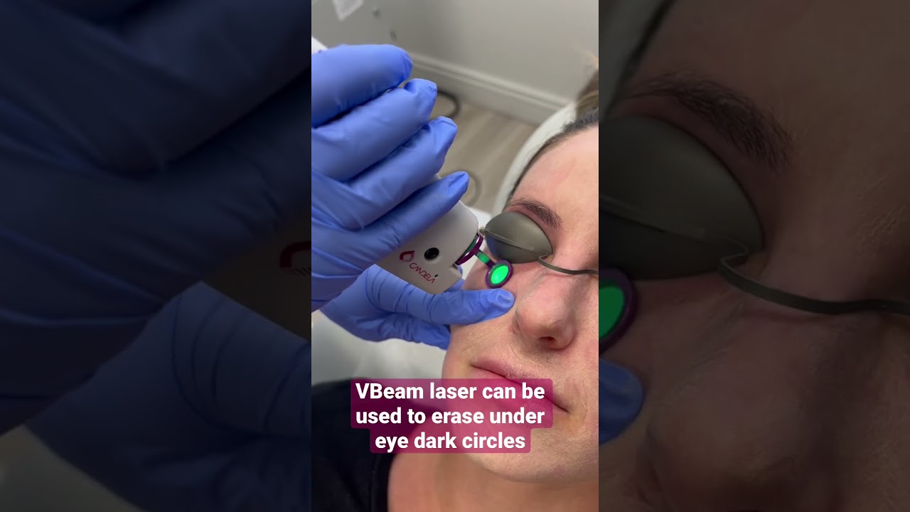 VBeam laser to erase under eye dark circles 