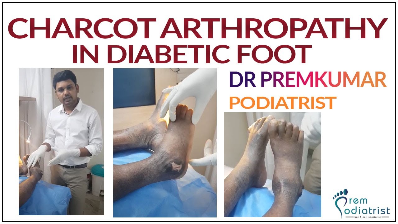 Charcot Arthropathy in diabetic foot.Dr.Premkumar(podiatric surgeon) YouTube