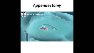 Appendix removal surgery is called Appendectomy 💉💊🩹🩺