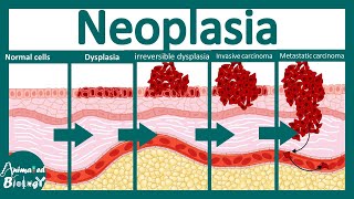 Neoplasia Pathology Underlying Neoplasia Usmle