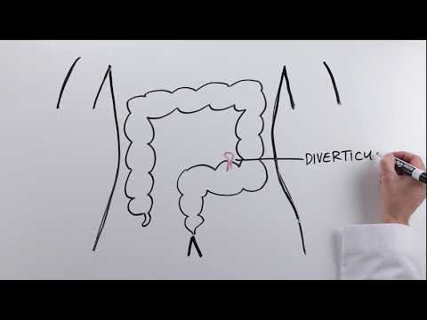 Video: Is sigmoidectomie hetzelfde als sigmoid colectomie?