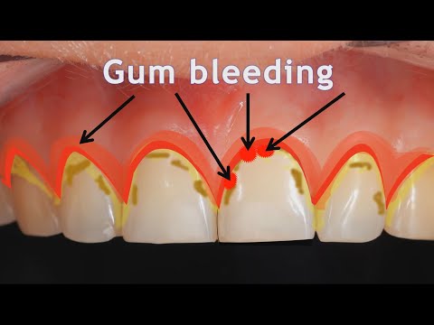 Gums: Gum Disease, Gingivitis and Periodontitis