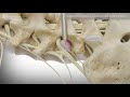Endoscopic Lumbar Discectomy | Spine Institute of North America