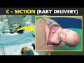 C-section (Cesarean Delivery) | How C-Section is Performed?