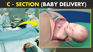 C-section (Cesarean Delivery) | How C-Section is Performed