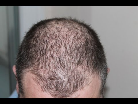 benefits of tea tree oil for hair loss