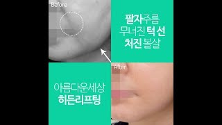 얼굴볼처짐 고민은 히든리프팅으로 개선해보세요 (안면거상수술비용,안면거상수술후기)
