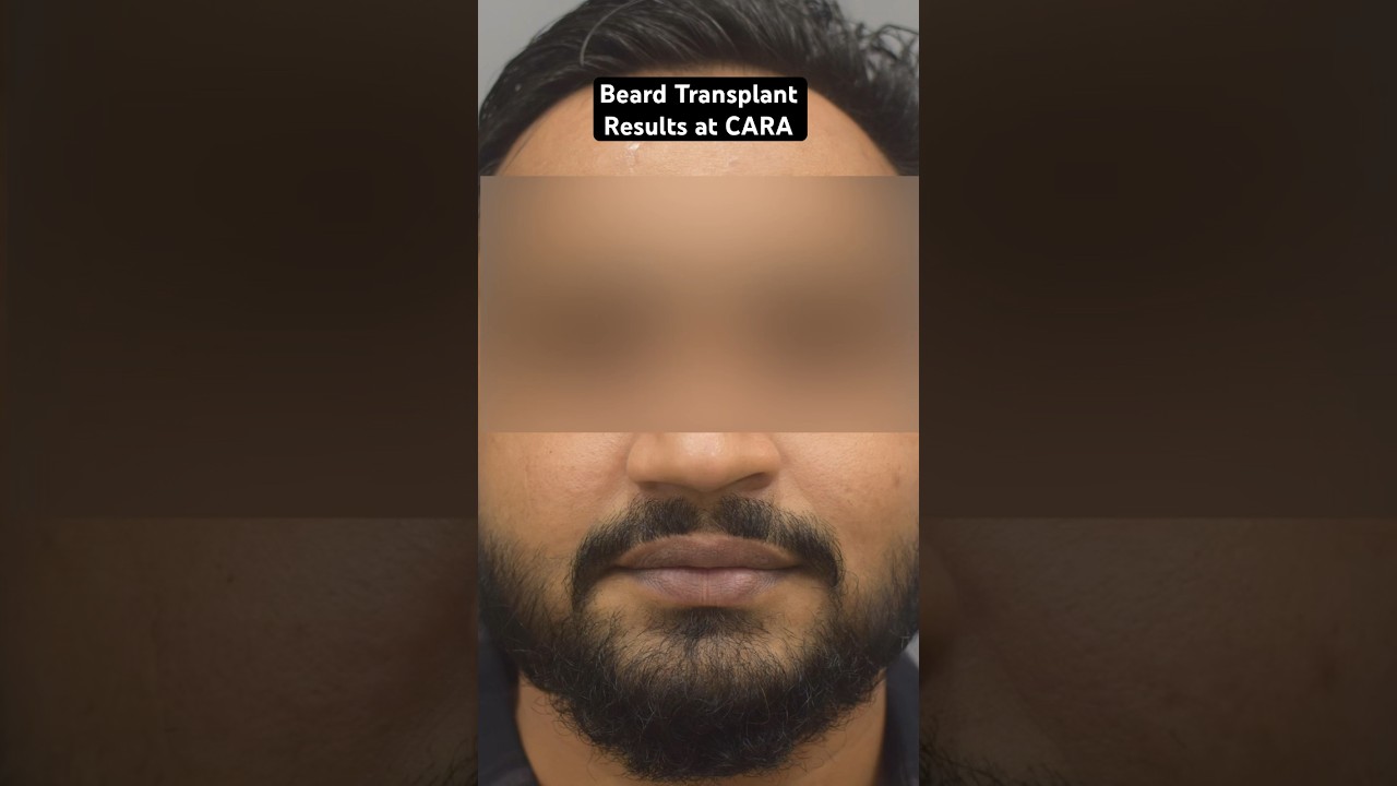 Beard Transplant Results at CARA Clinic