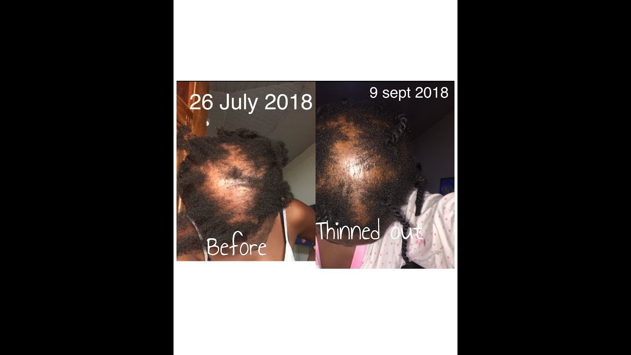 What A Prescribed Steroid Cream By a Dermatologist Did to My New