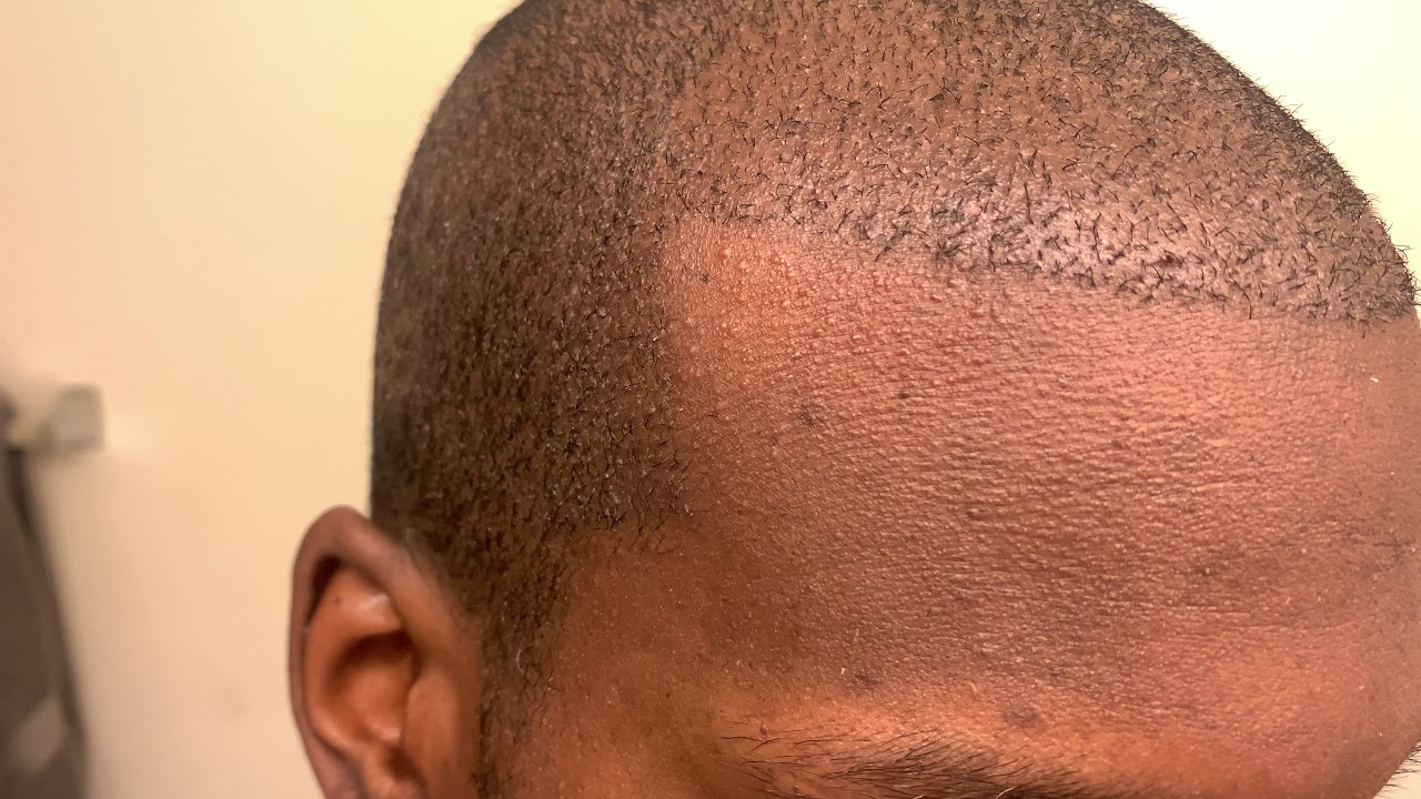 Hair Transplant Vlog | Day 12 Scab Wash Out | African American Hair | Asli Tarcan