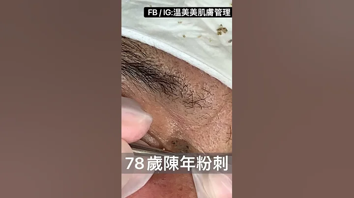 超疗愈陈年粉刺-不看会后悔 - 天天要闻