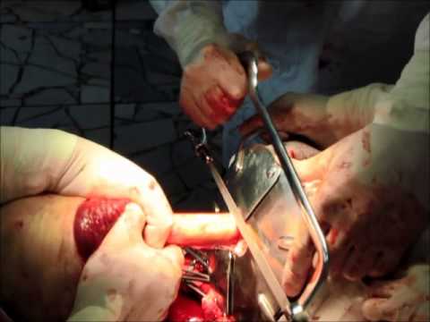 Video: Gangrenos Gydymas Be Amputacijos