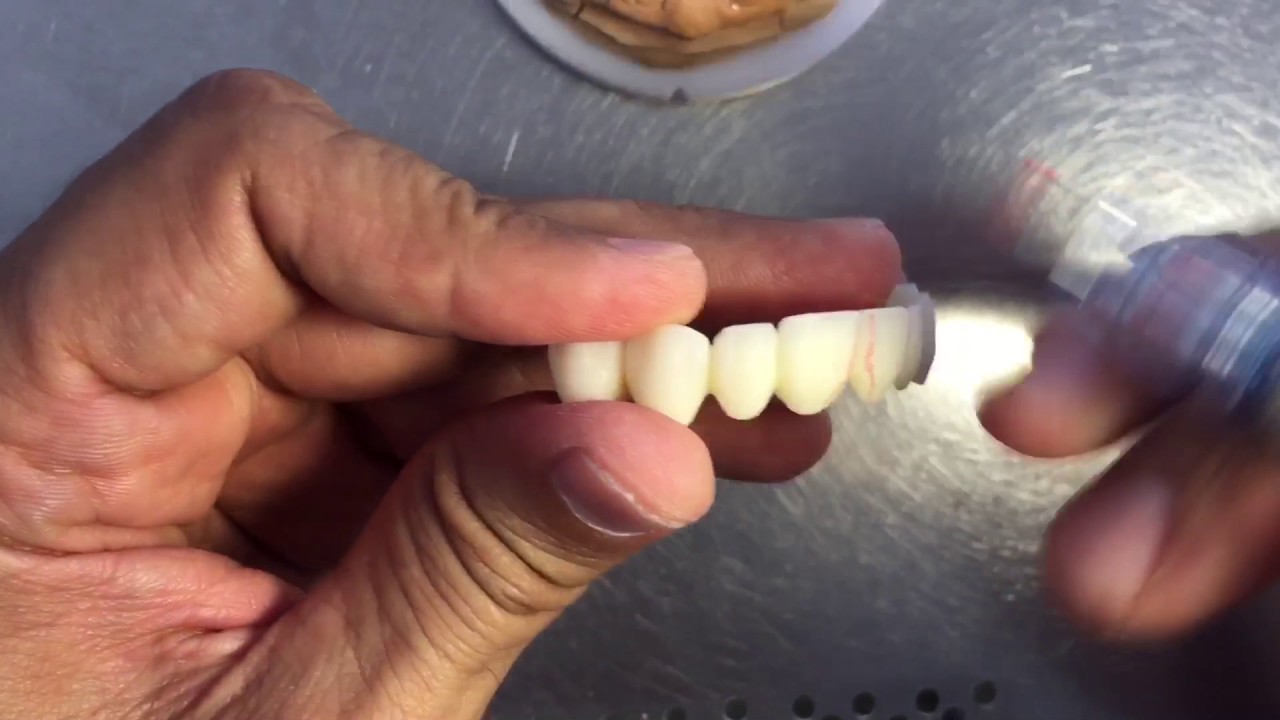 Puente en zirconio y líneas y textura