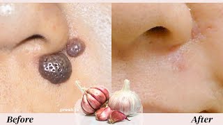 Japanese anti aging secret to remove skin tags with garlic in 3 days / garlic skin tag removal fast