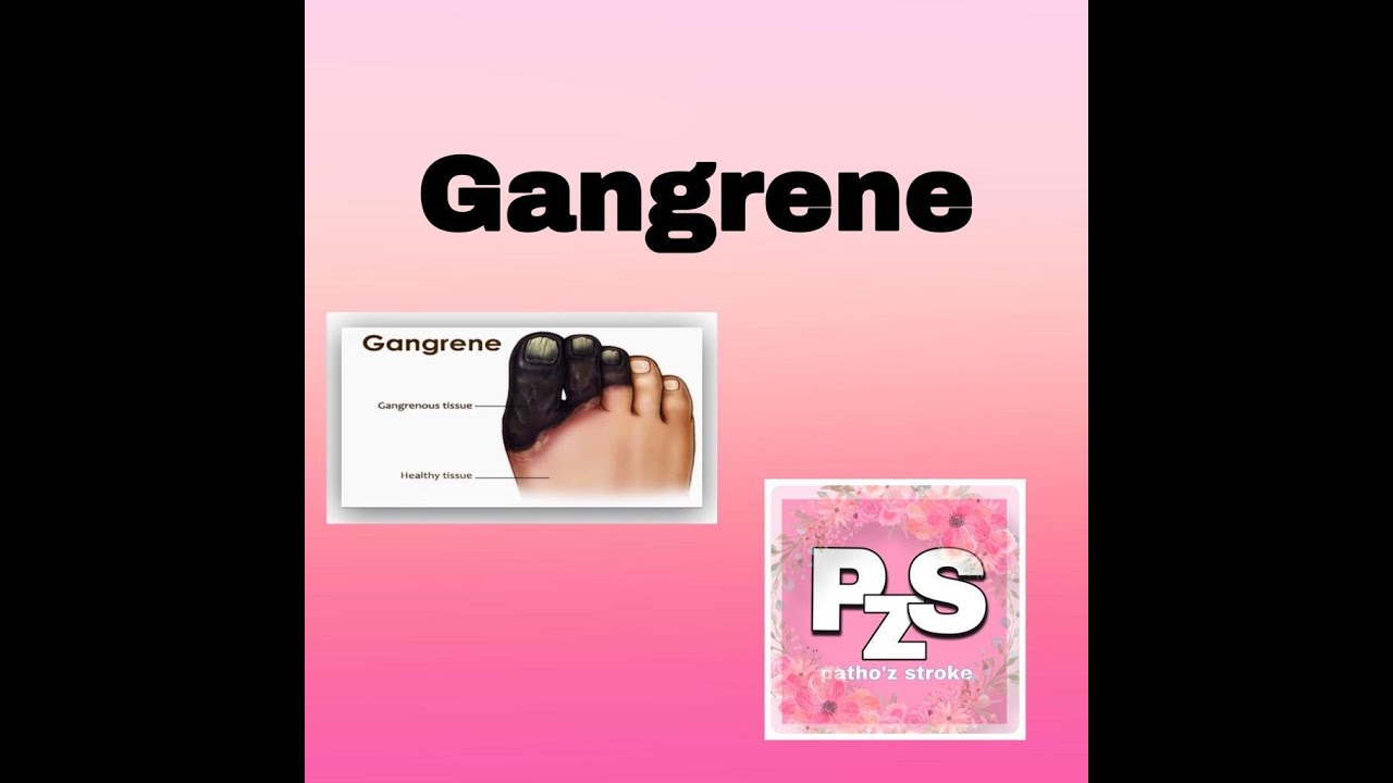 Gangrene