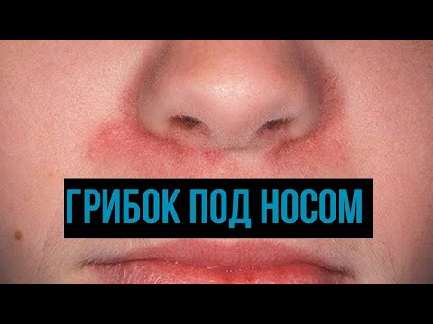 Видео: Зачервяване около носа: 10 причини, лечения и други