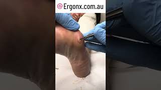 Painful Corn Removed By Podiatrist