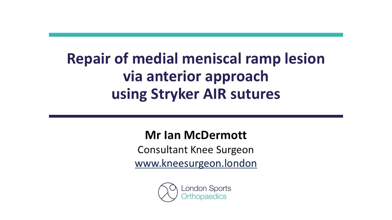 Ramp Lesion repair with the Stryker AIR - YouTube