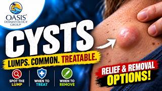 Skin Cysts: Why These Bumps Form Under the Skin