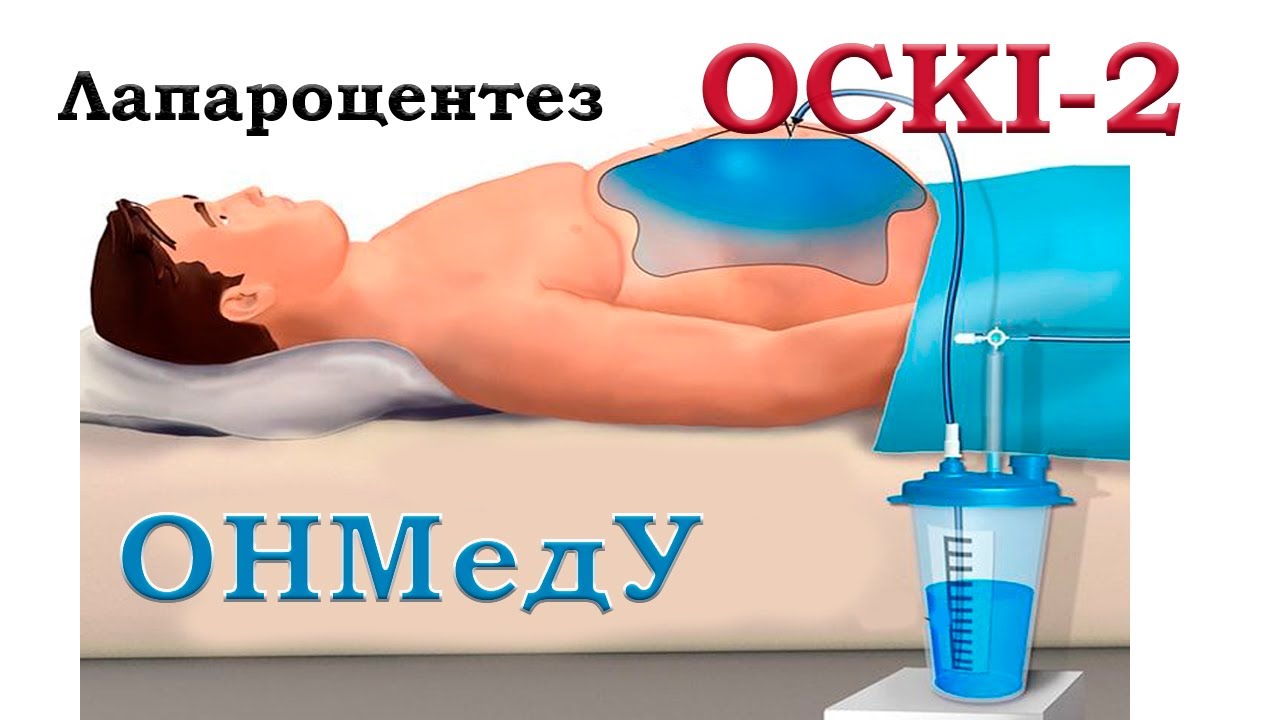 ОСКІ-2. ЛАПАРОЦЕНТЕЗ - YouTube