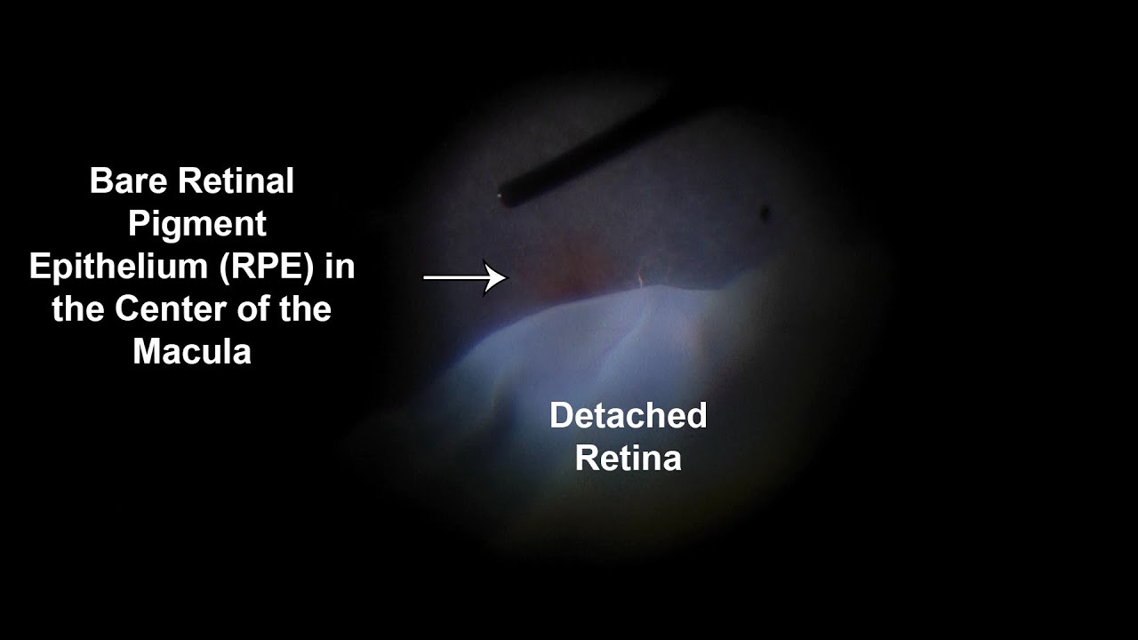 Giant Retinal Tear Retinal Detachment Repair Perfluoron Laser Oil YouTube