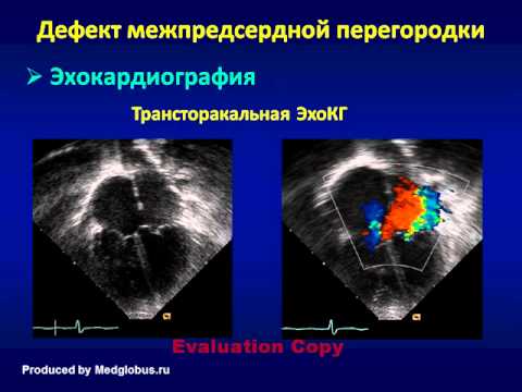 ДМПП или дефект межпредсердной перегородки: причины, симптомы, диагностика и лечение ДМПП