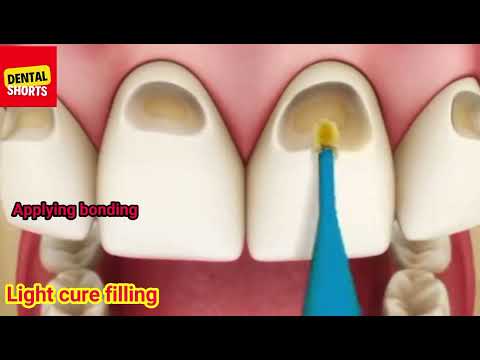 Light Cure Filling Composite Filling Dant Min Keeda Ka Ilaj Teeth Filling Asmr Asmr 