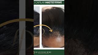 O que é Alopecia Areata? #quedadecabelo #alopecia