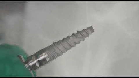 Sinus Communication Repaired with 3D Bond & Bond Apatite® - Michael Katzap DDS