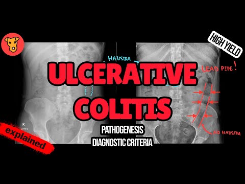 Ulcerative Colitis Pathogenesis Diagnostic Criteria Toxic Megacolon Treatment