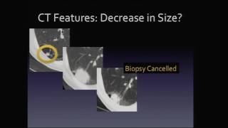 Thoracic Imaging:  Pulmonary Nodule – David Naeger, MD