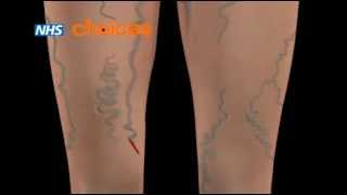 靜脈曲張-形成及治療方式介紹(Varicose veins  NHS)