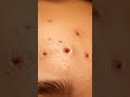 “Satisfying Pore Vacuum Blackhead Cleaning You Can’t Miss!”