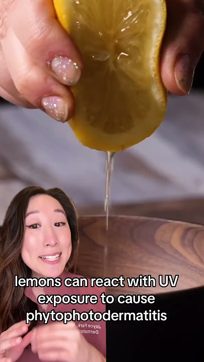 Lemon on #pimples? That's a no from me! #Lemon on skin can lead to #rashes and NOT #radiance