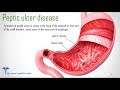 Peptic Ulcer symptoms,signs, investigations and complications Peptic Ulcer symptoms,signs, investigations and complications